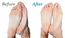 Load image into Gallery viewer, Emjoi Micro Pedi White Callus Remover with Extra Coarse Roller & Cleaning Brush (AP-3RPS)